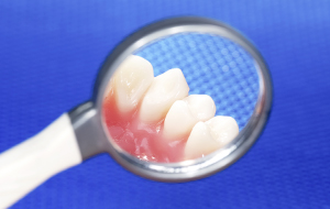 長崎市・とどデンタルクリニック・周囲の歯がむし歯、歯周病になりやすくなる